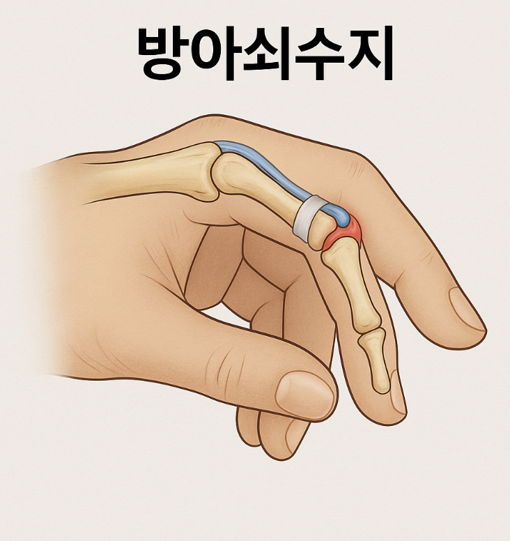 방아쇠수지